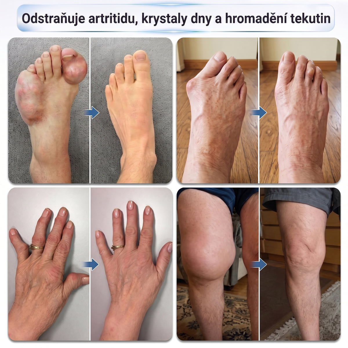 OFICIÁLNÍ OBCHOD | IFMAGIC® 0,05 mm Mikroneedle Rychle Působící Roll-On pro Úlevu Kloubů a Kostí🎃