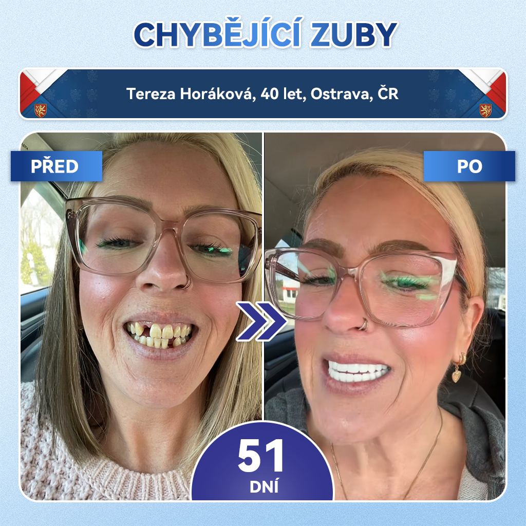 𝐺𝒍𝒊𝗆𝗆𝑒𝑟𝗹𝘆®🦷 𝑇𝑖𝑑𝑒𝑔𝑙𝑢𝑠𝑖𝑏 𝑀𝑖𝑐𝑟𝑜𝑛𝑒𝑒𝑑𝑙𝑒 𝑃𝑎𝑡𝑐ℎ 𝑛𝑎 𝑜𝑝𝑟𝑎𝑣𝑢 𝑧𝑢𝑏ů 𝑎 𝑑á𝑠𝑛í | 𝑃𝑜𝑘𝑟𝑜č𝑖𝑙é 𝑛á𝑝𝑙𝑎𝑠𝑡𝑖 𝑝𝑟𝑜 𝑎𝑘𝑡𝑖𝑣𝑎𝑐𝑖 𝑘𝑚𝑒𝑛𝑜𝑣ý𝑐ℎ 𝑏𝑢𝑛ě𝑘 𝑧𝑢𝑏ů 👩‍⚕️(𝑶𝒃𝒏𝒐𝒗𝒂 𝒛𝒖𝒃𝒏í 𝒔𝒌𝒍𝒐𝒗𝒊𝒏𝒚 𝒂 𝒅𝒆𝒏𝒕𝒊𝒏𝒖 • 𝑷𝒐𝒔í𝒍𝒆𝒏í 𝒅á𝒔𝒏í • 𝑶𝒅𝒔𝒕𝒓𝒂𝒏ě𝒏í 𝒛𝒖𝒃𝒏í𝒉𝒐 𝒌𝒂𝒎𝒆𝒏𝒆 𝒂 𝒛á𝒑𝒂𝒄𝒉𝒖 • 𝒁𝒂𝒔𝒕𝒂𝒗𝒆𝒏í 𝒄𝒊𝒕𝒍𝒊𝒗𝒐𝒔𝒕𝒊 𝒛𝒖𝒃ů)🔥