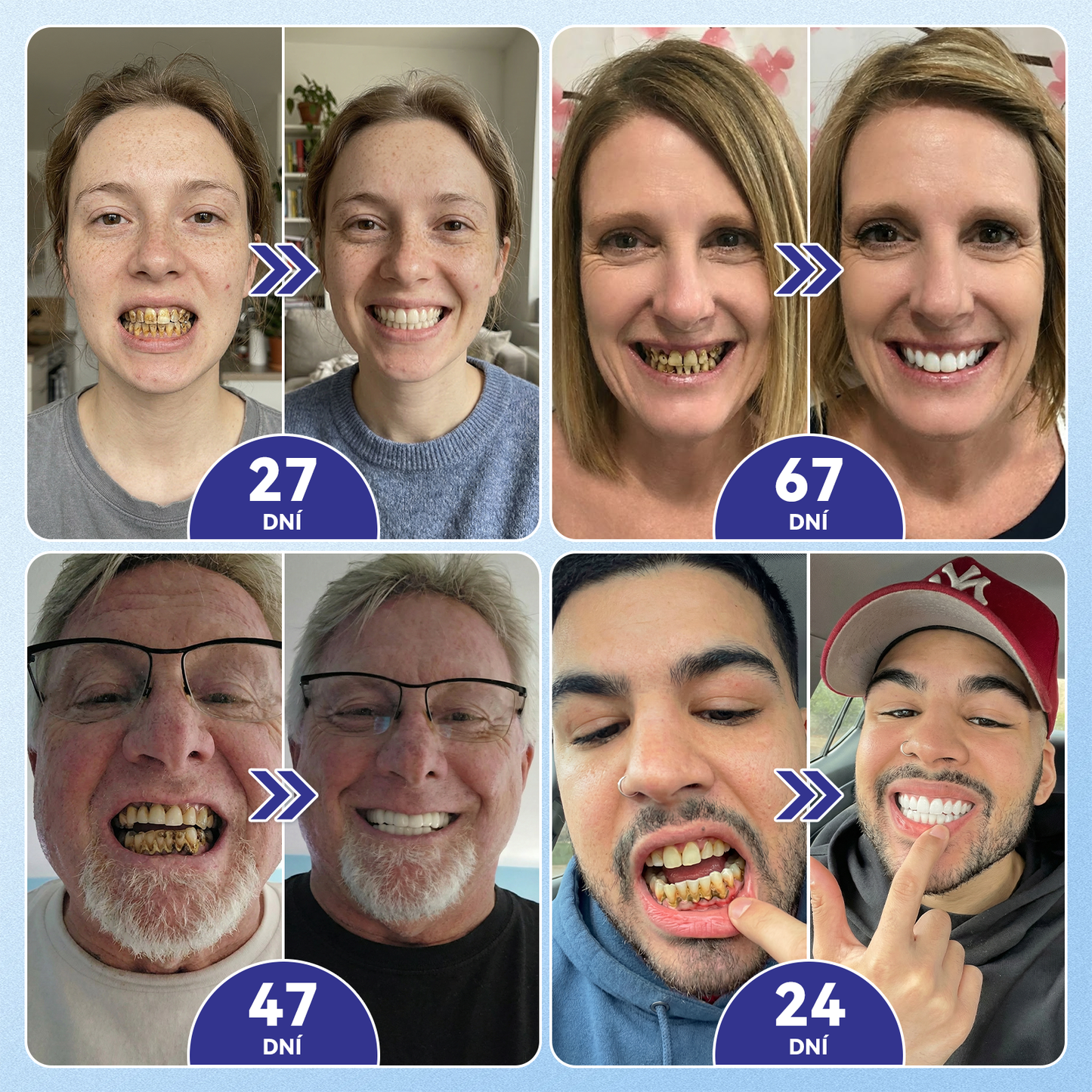 𝐺𝒍𝒊𝗆𝗆𝑒𝑟𝗹𝘆®🦷 𝑇𝑖𝑑𝑒𝑔𝑙𝑢𝑠𝑖𝑏 𝑀𝑖𝑐𝑟𝑜𝑛𝑒𝑒𝑑𝑙𝑒 𝑃𝑎𝑡𝑐ℎ 𝑛𝑎 𝑜𝑝𝑟𝑎𝑣𝑢 𝑧𝑢𝑏ů 𝑎 𝑑á𝑠𝑛í | 𝑃𝑜𝑘𝑟𝑜č𝑖𝑙é 𝑛á𝑝𝑙𝑎𝑠𝑡𝑖 𝑝𝑟𝑜 𝑎𝑘𝑡𝑖𝑣𝑎𝑐𝑖 𝑘𝑚𝑒𝑛𝑜𝑣ý𝑐ℎ 𝑏𝑢𝑛ě𝑘 𝑧𝑢𝑏ů 👩‍⚕️(𝑶𝒃𝒏𝒐𝒗𝒂 𝒛𝒖𝒃𝒏í 𝒔𝒌𝒍𝒐𝒗𝒊𝒏𝒚 𝒂 𝒅𝒆𝒏𝒕𝒊𝒏𝒖 • 𝑷𝒐𝒔í𝒍𝒆𝒏í 𝒅á𝒔𝒏í • 𝑶𝒅𝒔𝒕𝒓𝒂𝒏ě𝒏í 𝒛𝒖𝒃𝒏í𝒉𝒐 𝒌𝒂𝒎𝒆𝒏𝒆 𝒂 𝒛á𝒑𝒂𝒄𝒉𝒖 • 𝒁𝒂𝒔𝒕𝒂𝒗𝒆𝒏í 𝒄𝒊𝒕𝒍𝒊𝒗𝒐𝒔𝒕𝒊 𝒛𝒖𝒃ů)🔥